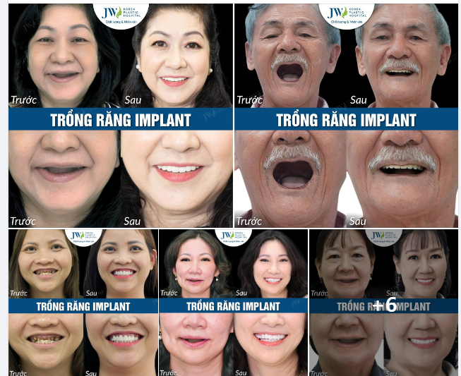 SỰ THAY ĐỔI NGOẠN MỤC SAU TRỒNG RĂNG IMPLANT TẠI JW