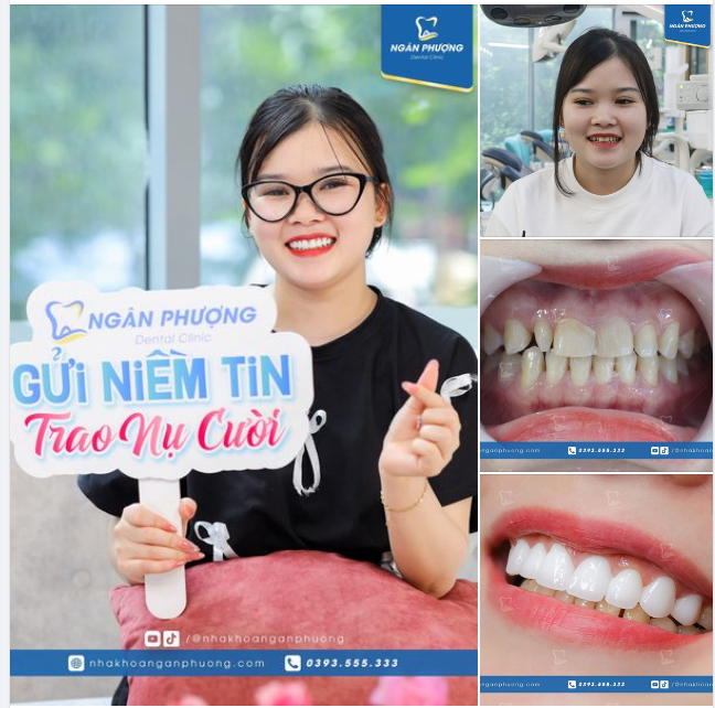 Chỉ bọc sứ hàm trên thì nụ cười có hoàn hảo?