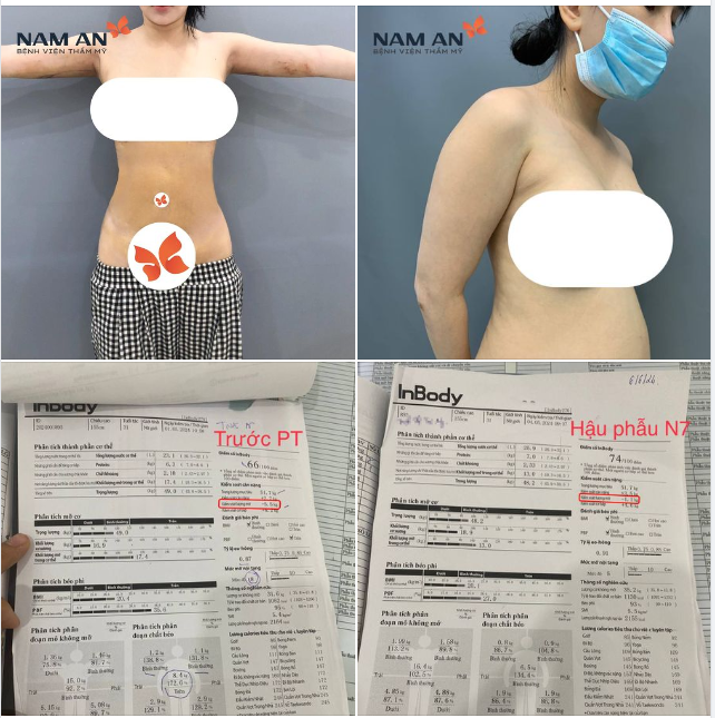 LOẠI BỎ 4.4 KG MỠ THỪA VÙNG BỤNG VÀ BẮP TAY VỚI CÔNG NGHỆ MICROAIR