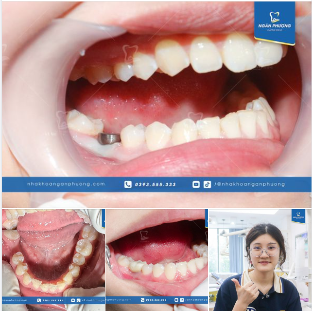 CẢNH BÁO! Độ tuổi mất răng 6 đang ngày càng trẻ hóa