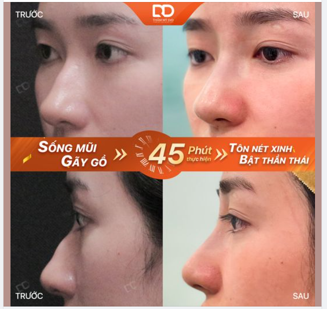 SỬA MŨI GỒ - ĐỔI TƯỚNG SỐ