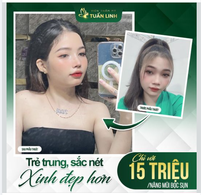 Trẻ trung, xinh đẹp sắc nét hơn chỉ với 15 triệu nâng mũi Sline bọc sụn tai!!