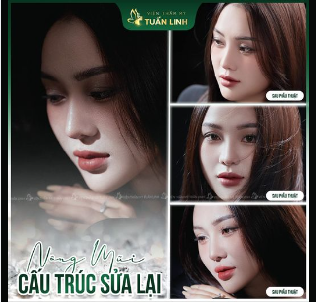 NÂNG MŨI SỬA LẠI - LUÔN LÀ MỘT CA NÂNG MŨI KHÓ!