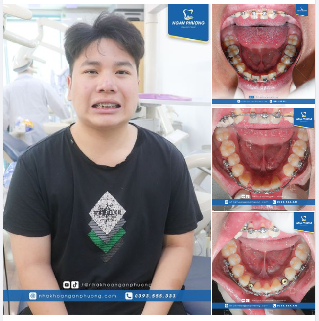 KHẮC PHỤC CA NIỀNG CỦA BẠN ĐÌNH PHONG