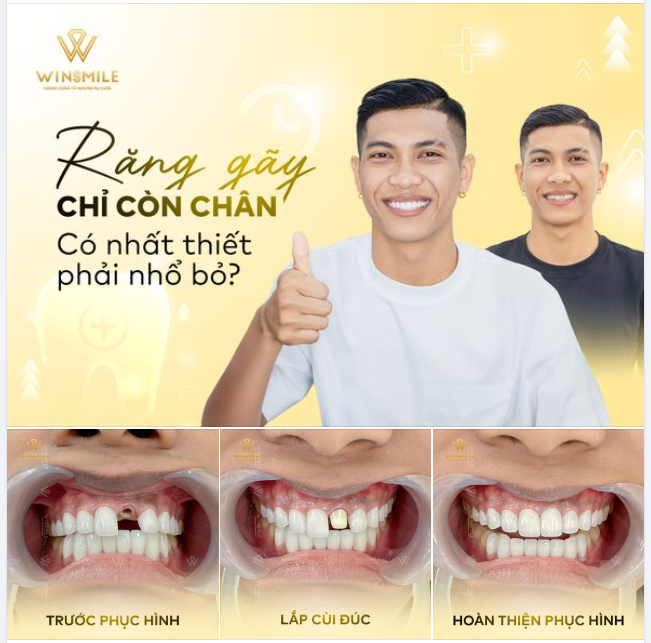 GIẢI PHÁP NÀO PHỤC HỒI RĂNG SÂU, VỠ, GÃY CHỈ CÒN CHÂN?