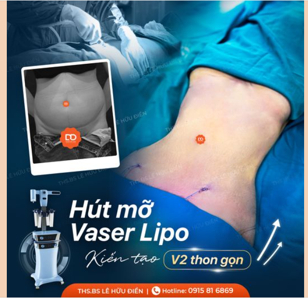 DỌN MỠ V2 - TẠM BIỆT BỤNG BÉO CHỈ VỚI 1H
