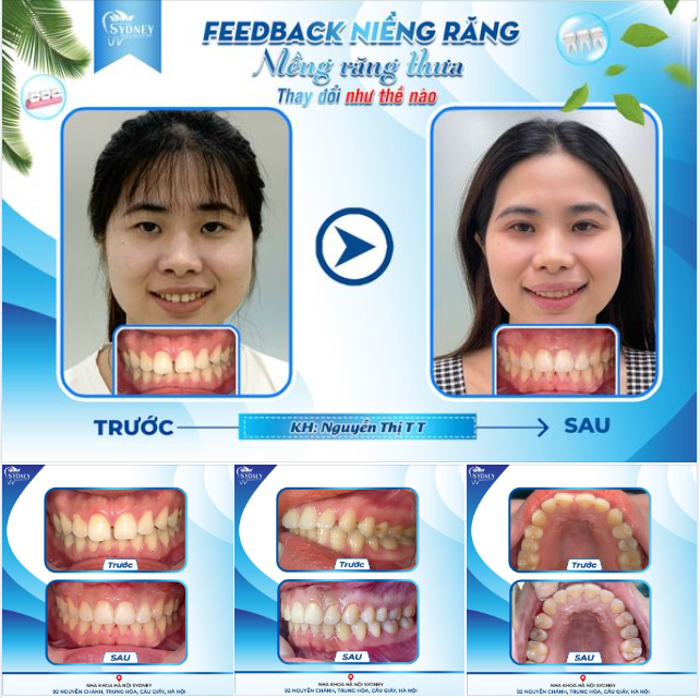 NIỀNG RĂNG THƯA THAY ĐỔI NHƯ THẾ NÀO?