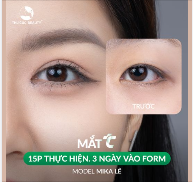 Cắt mí như ý - Chi phí li ti chỉ trong tháng 6 này tại Thu Cúc