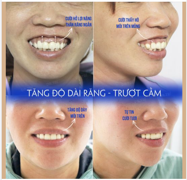 Lấy lại nụ cười tự tin cho chị gái bị cười hở lợi, cằm vuông ngắn