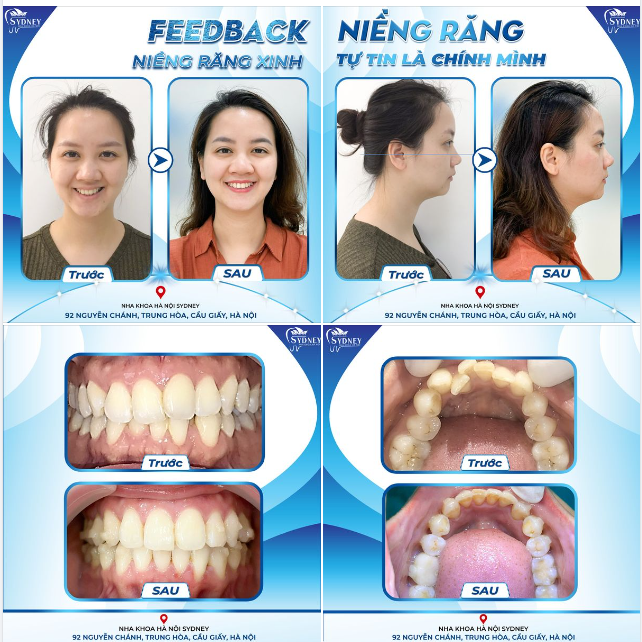 NIỀNG RĂNG XINH - TỰ TIN LÀ CHÍNH MÌNH