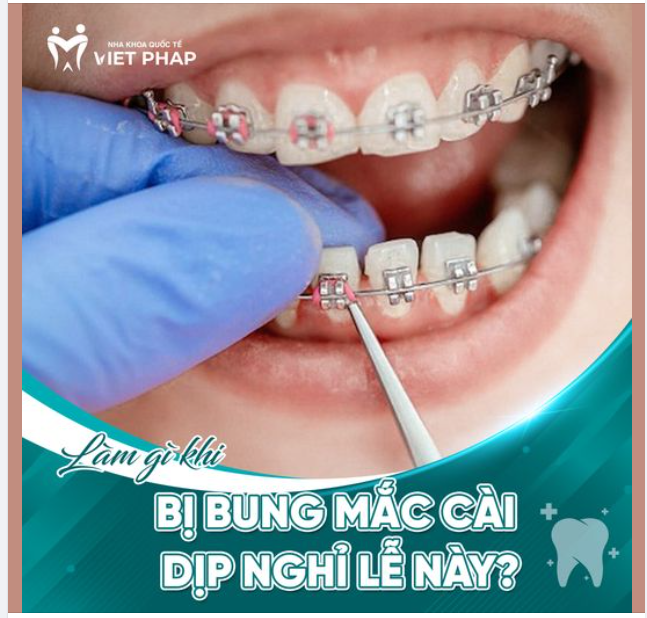 LÀM GÌ KHI BỊ BUNG MẮC CÀI DỊP NGHỈ LỄ NÀY