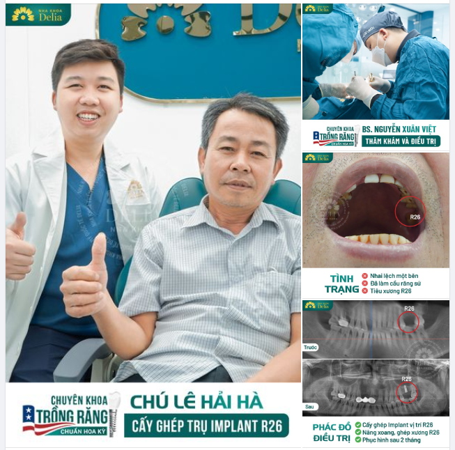 Trải nghiệm trồng răng “không đau” tại nha khoa Delia