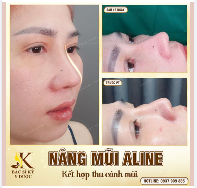 MẶT ĐẸP ĐIỂM 10 SAU 15 NGÀY NÂNG MŨI ALINE