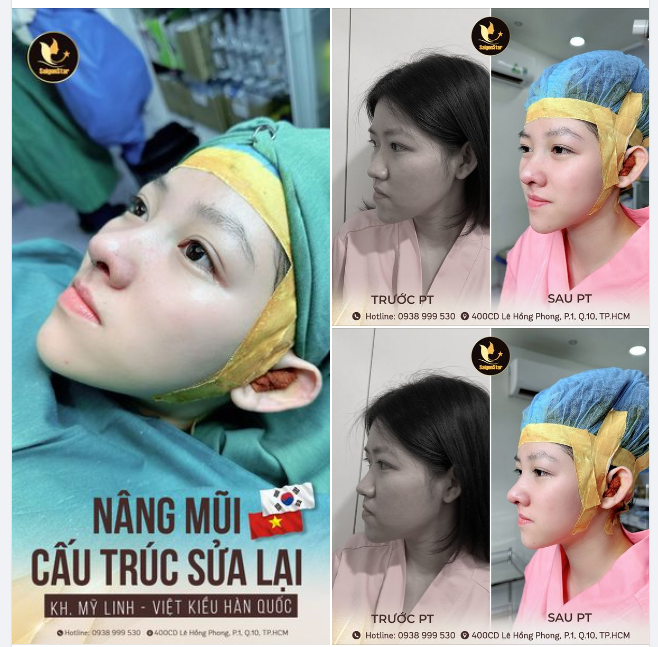 THÀNH CÔNG TÁI TẠO LẠI DÁNG MŨI MỚI CHO BẠN DU HỌC SINH HÀN QUỐC