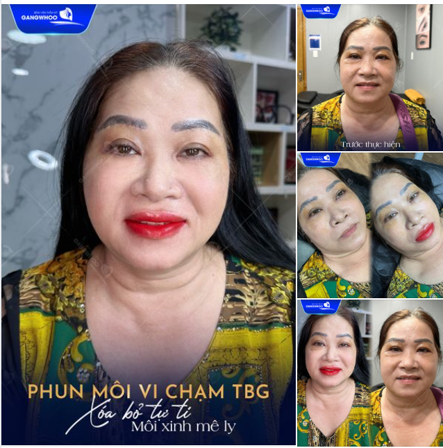 PHUN MÔI VI CHẠM TBG