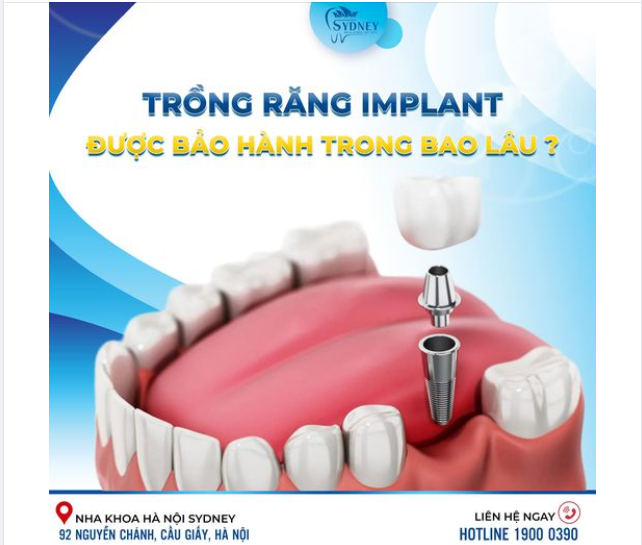 CẤY IMPLANT ĐƯỢC BẢO HÀNH TRONG BAO LÂU?