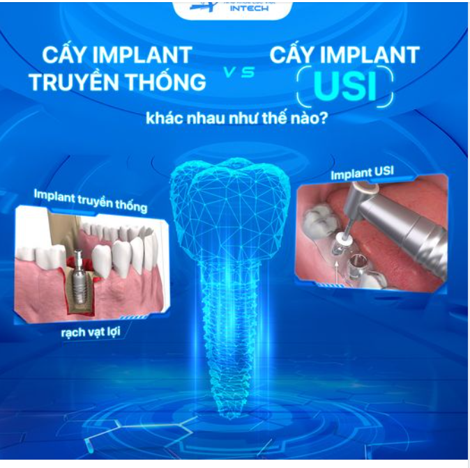 CẤY GHÉP USI KHẮC PHỤC HOÀN TOÀN NHƯỢC ĐIỂM CỦA CẤY GHÉP IMPLANT TRUYỀN THỐNG