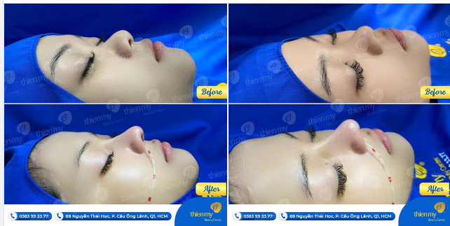 “Kết quả” là minh chứng vì sao Quý khách hàng luôn tin tưởng là lựa chọn PKCK Thiện Mỹ là điểm đến để làm đẹp