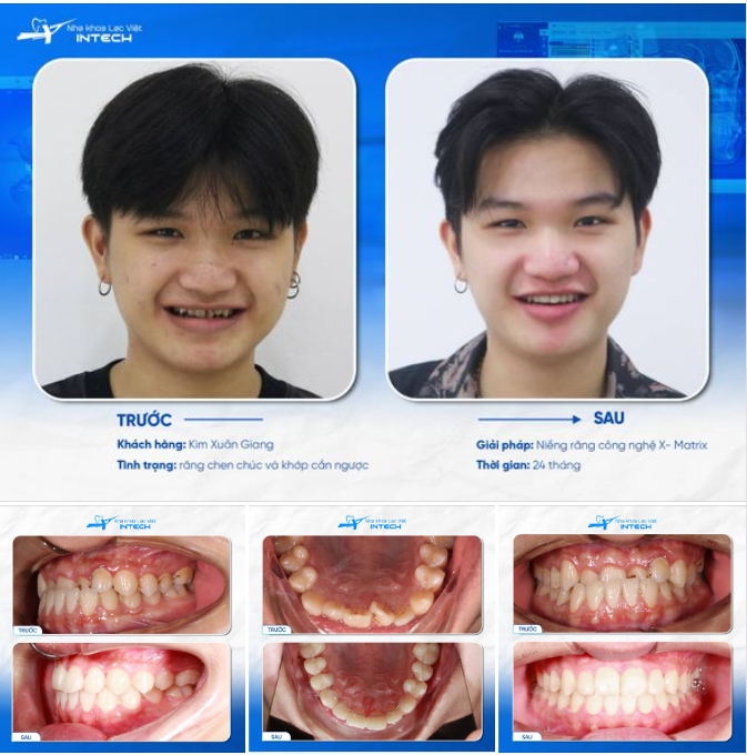 NGỠ GẶP HOTBOY TRONG GƯƠNG SAU 2 NĂM NIỀNG RĂNG