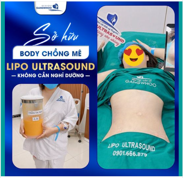 GIẢM MỠ LIPO ULTRASOUND ĐỂ SỞ HỮU BODY CHỒNG MÊ NHÉ CHỊ EM!!!