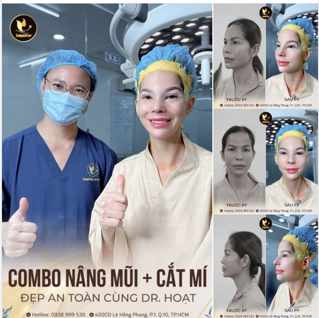 Chị khách hàng trao trọn niềm tin cho Dr. Hoạt, mạnh tay chốt đơn COMBO NÂNG MŨI + CẮT MÍ !  Và cái kết vô cùng xứng đáng, không một điểm trừ!