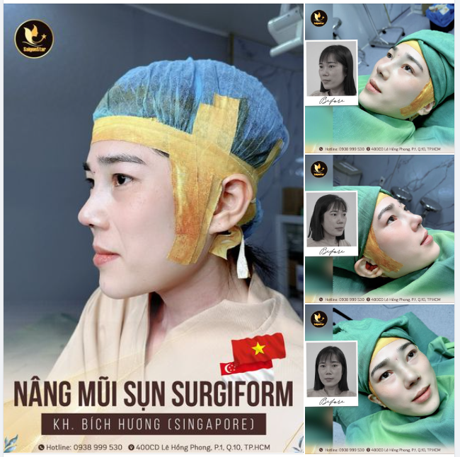 KẾT QUẢ NÂNG MŨI SỤN SURGIFORM CHO CHỊ KHÁCH HÀNG ĐẾN TỪ SINGAPORE