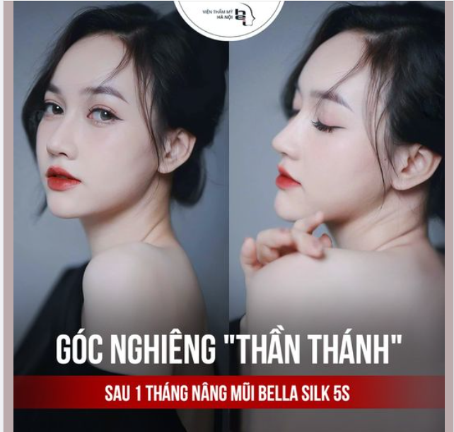 DEAL HOT NÂNG MŨI BELLA SILK 5S TẠI VTMHN