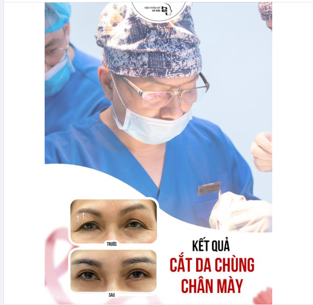 Phương pháp CẮT DA CHÙNG CHÂN MÀY KHÔNG KHÂU DA được đánh giá là mang lại hiệu quả nhất cho việc cải thiện vùng da mắt bị lão hóa.