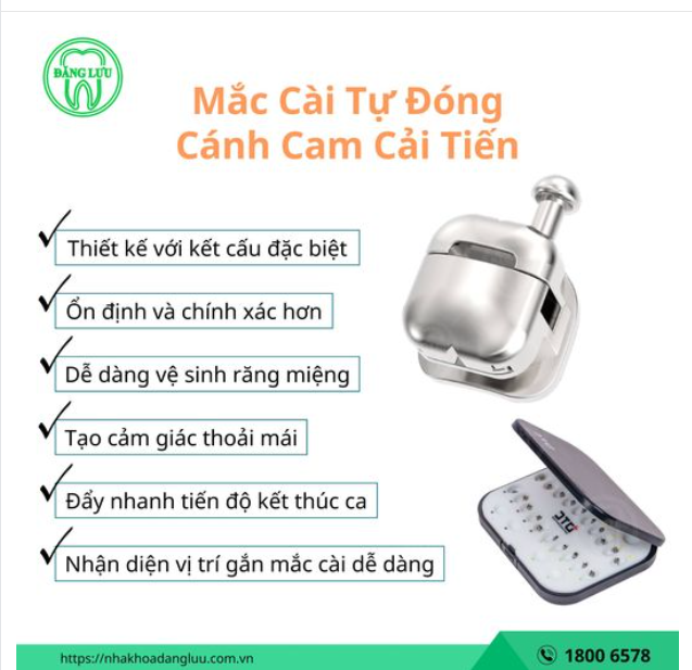 NIỀNG RĂNG VỚI MẮC CÀI TỰ ĐÓNG CÁNH CAM CẢI TIẾN, tại sao không?