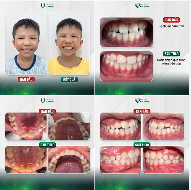 CHƯA ĐẦY 3 THÁNG, HOÀN THIỆN NỤ CƯỜI CHO BÉ VỚI TIỀN CHỈNH NHA