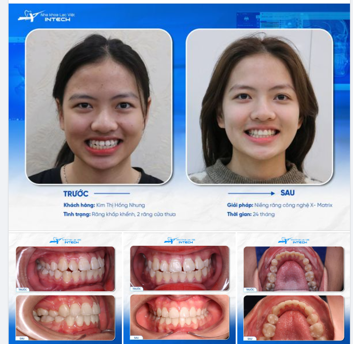 "NẾU KHÔNG QUYẾT ĐỊNH NIỀNG RĂNG, LÀM SAO GẶP ĐƯỢC PHIÊN BẢN TỐT HƠN CỦA CHÍNH MÌNH?"