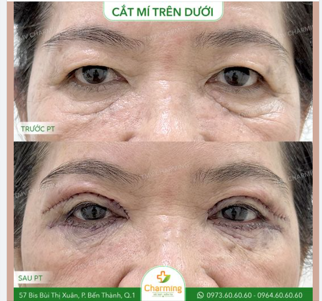 Cắt mí từ lâu đã được xem là 1 trong những phương pháp hiệu quả trong việc níu kéo tuổi xuân ở vùng mắt.