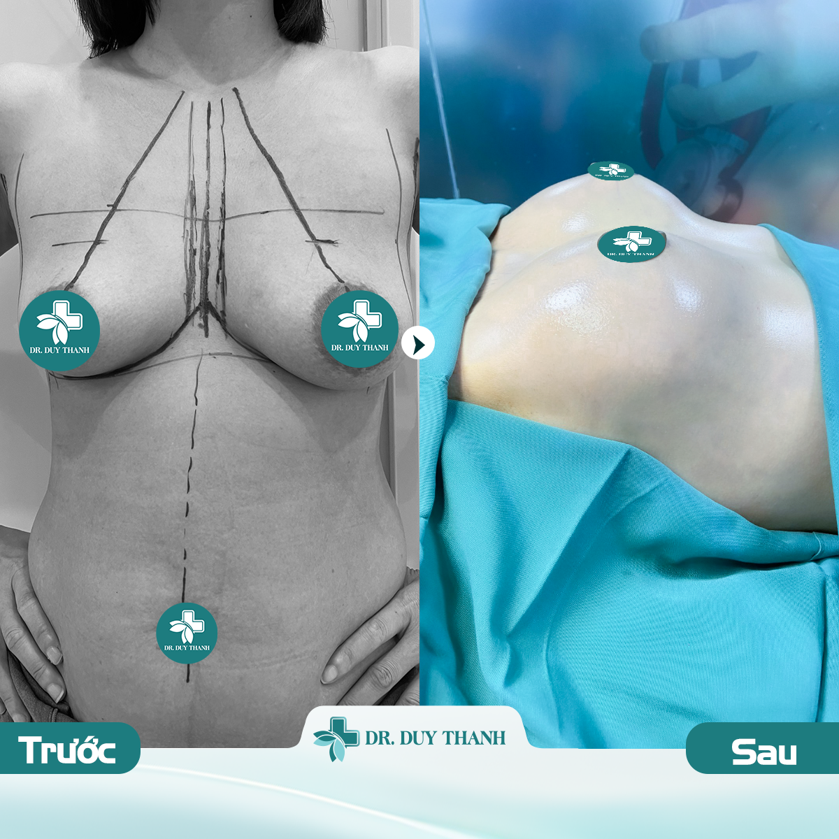 Sa trễ sau sinh gặp Dr Duy Thanh là giải quyết được hết