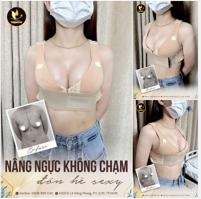 NÂNG NGỰC KHÔNG CHẠM - THOÁT LÉP SAU 60 PHÚT