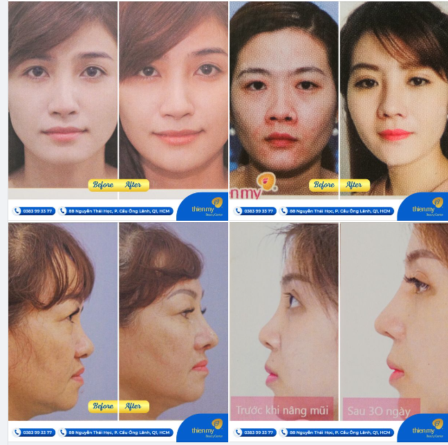 Nâng mũi thành công không chỉ CHẤT LƯỢNG SỤN - mà còn yếu tố KỸ THUẬT vô cùng quan trọng!