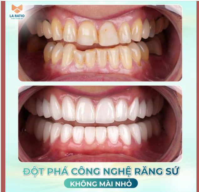 ĐỘT PHÁ CÔNG NGHỆ RĂNG SỨ KHÔNG MÀI NHỎ - CHUẨN ĐẸP TỰ NHIÊN