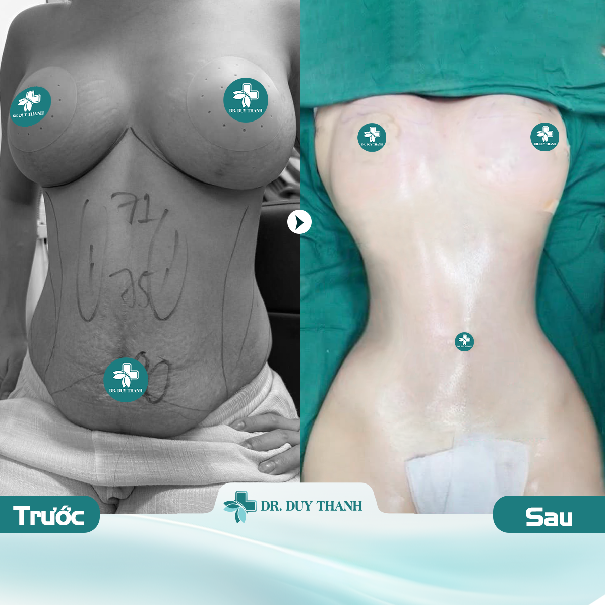 Cận cảnh body không điểm trừ nhờ bàn tay vàng Dr Duy Thanh