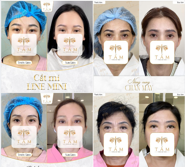 Khách hàng luôn hài lòng với kết quả sau khi thực hiện dịch vụ Cắt mí - Nâng cung chân mày tại TMV Tấm.
