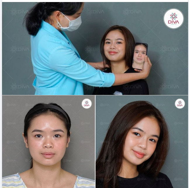 MŨI CAO TỰ NHIÊN, THU HÚT SAU 15 PHÚT NÂNG MŨI TINY POINT
