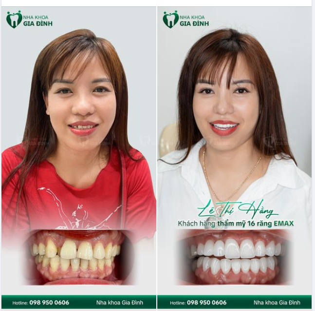 BIẾN MONG MUỐN THÀNH HIỆN THỰC CHỈ SAU 2 LẦN HẸN CÙNG CHUYÊN GIA