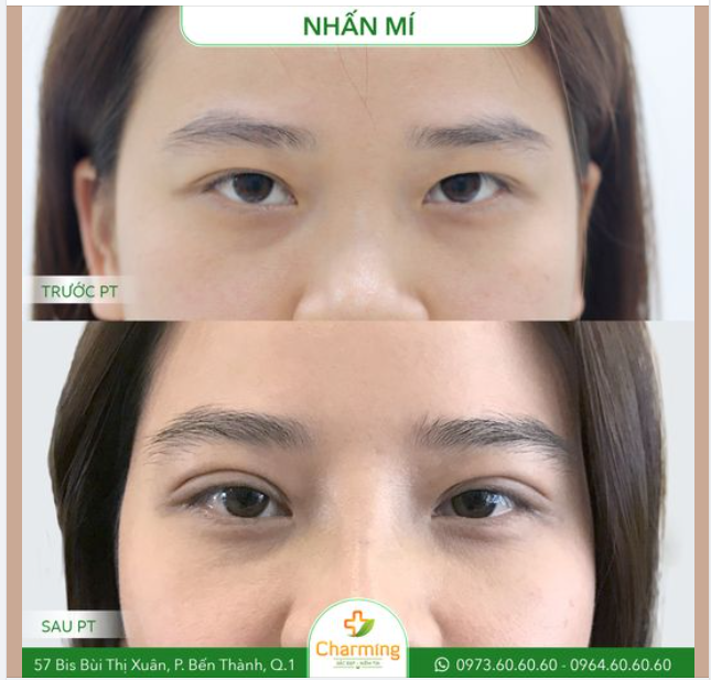 Sau phẫu thuật nhấn mí tại Charming, đôi mắt trước đây làm nàng khách tự ti bây giờ đã được hô biến trở thành đôi mắt 2 mí khiến nàng tự hào