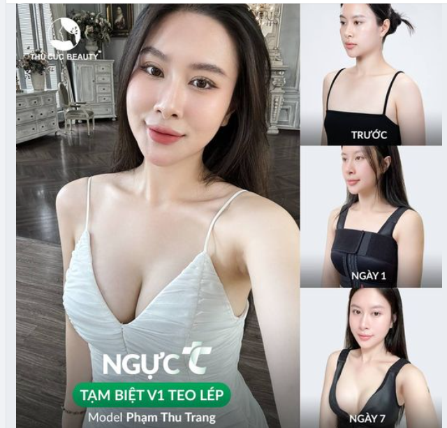 Quá trình biến hóa V1 teo lép thành "núi đôi" căng tròn mềm mại của Hotmom 2 con Thu Trang