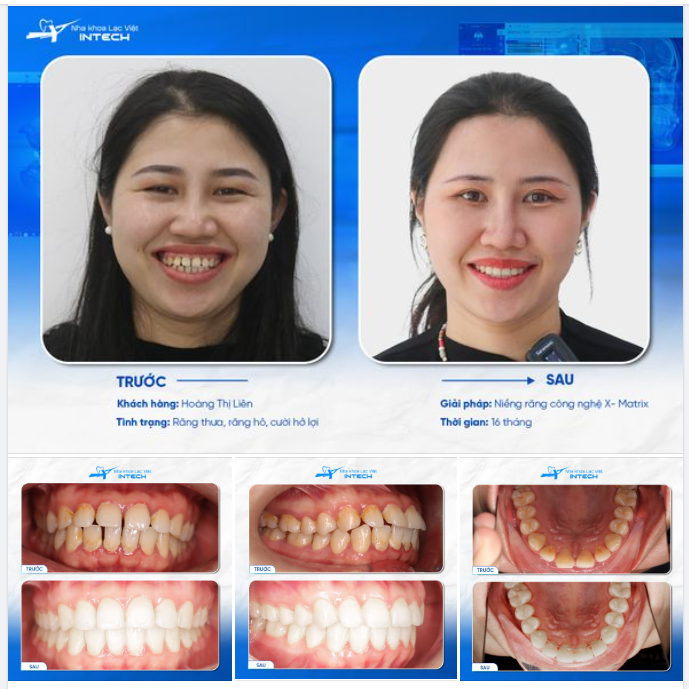 THĂNG HẠNG DIỆN MẠO ĐÁNG KINH NGẠC CHỈ SAU 16 THÁNG NIỀNG RĂNG X-MATRIX