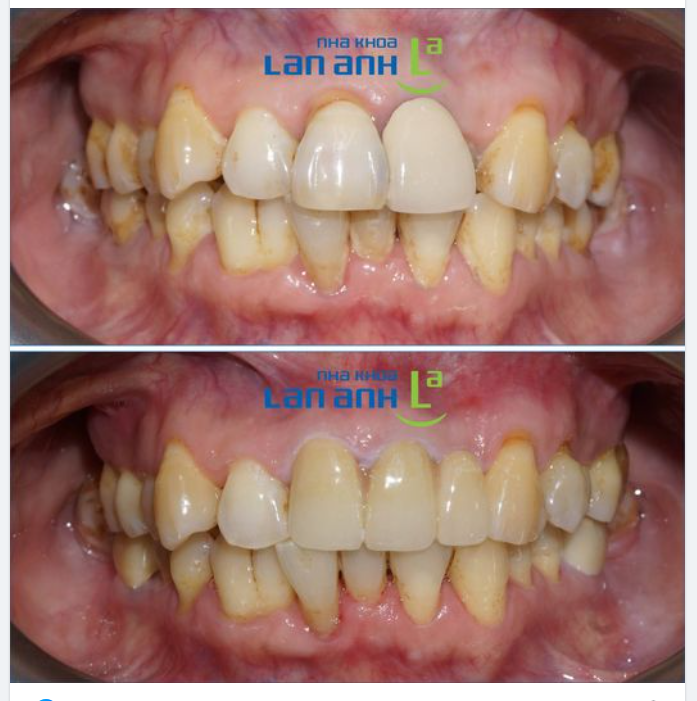  Khách hàng làm lại 3 răng sứ Direkt cho vùng răng cửa được thực hiện bới bs.Tùng - CN 130 Hà Huy Tập, P.Tân Phong, Q7.