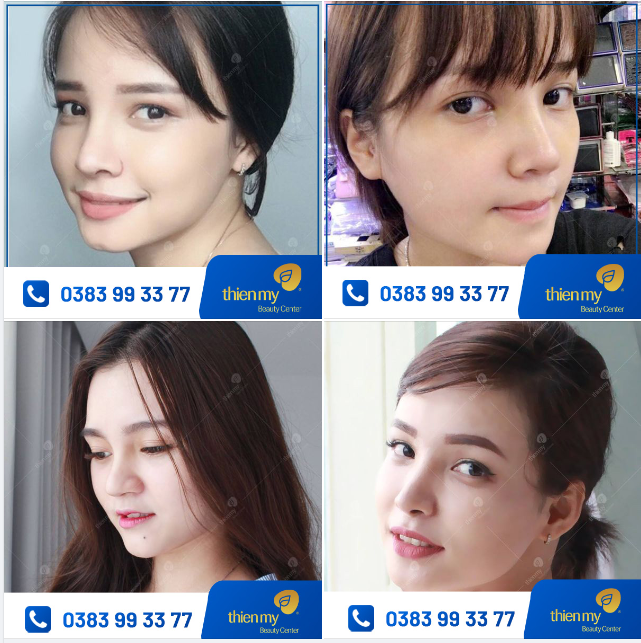 TÌM HIỂU "Công thức bí mật" khiến khách hàng đến với PKCK Thiện Mỹ để nâng mũi.
