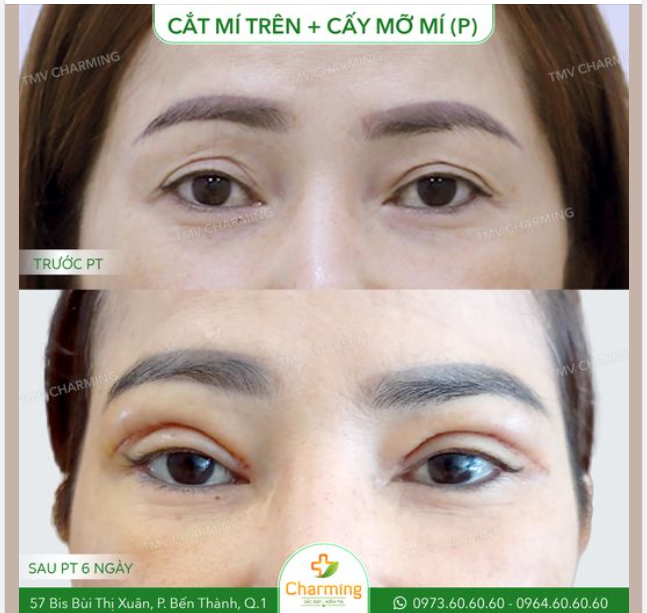 Tuy mới phẫu thuật được 6 ngày nhưng đôi mắt của nàng khách đã được cải thiện đáng kể.