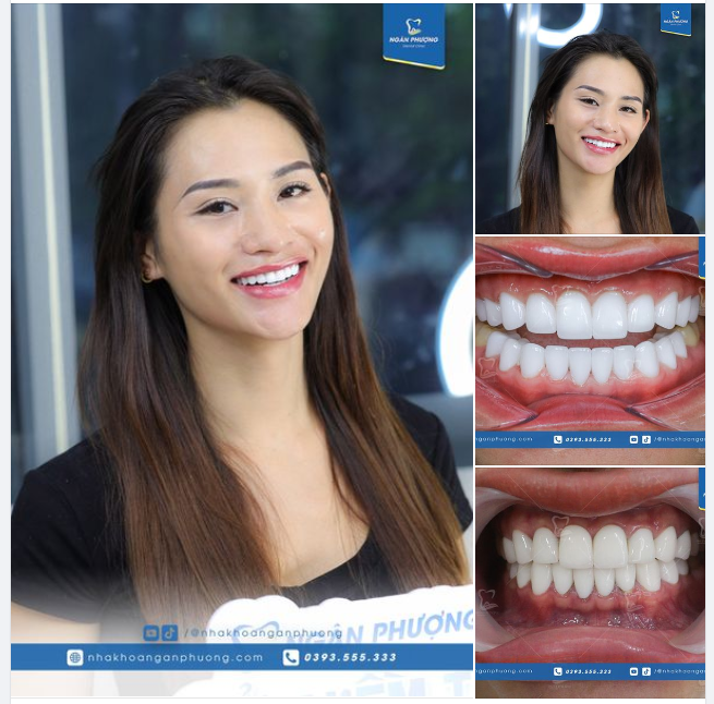 "Sửa" bộ răng sứ bị viêm lợi cho bạn Xuân Quỳnh