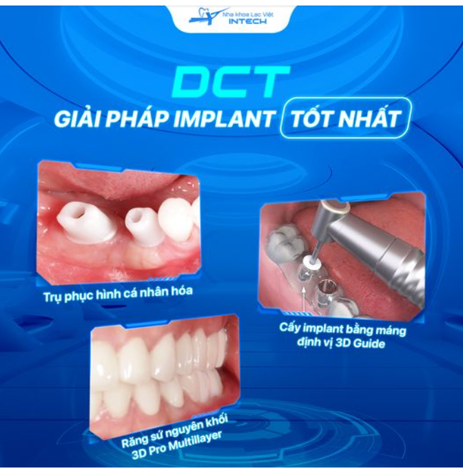 DCT - GIẢI PHÁP IMPLANT TỐT NHẤT HIỆN NAY GIÚP KHÁCH HÀNG ĂN NHAI BỀN VỮNG!