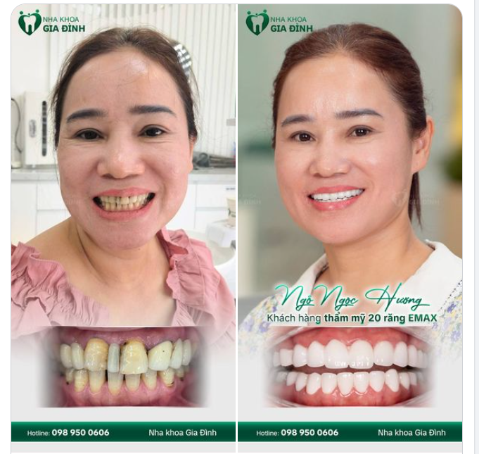 NGHIÊN CỨU 1 NĂM TRỜI VÀ CHỊ NGÔ HƯƠNG ĐÃ QUYẾT ĐỊNH CHỌN NHA KHOA GIA ĐÌNH ĐỂ TÂN TRANG NỤ CƯỜI