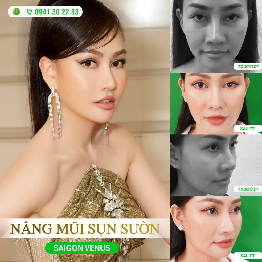 Á HẬU MC KIM DUYÊN THAY ĐỔI HOÀN TOÀN SAU NÂNG MŨI